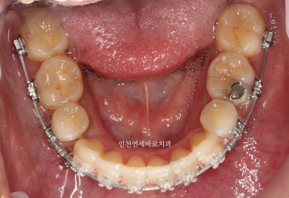 앞니가 부러진 경우 임플란트 안하는 방법