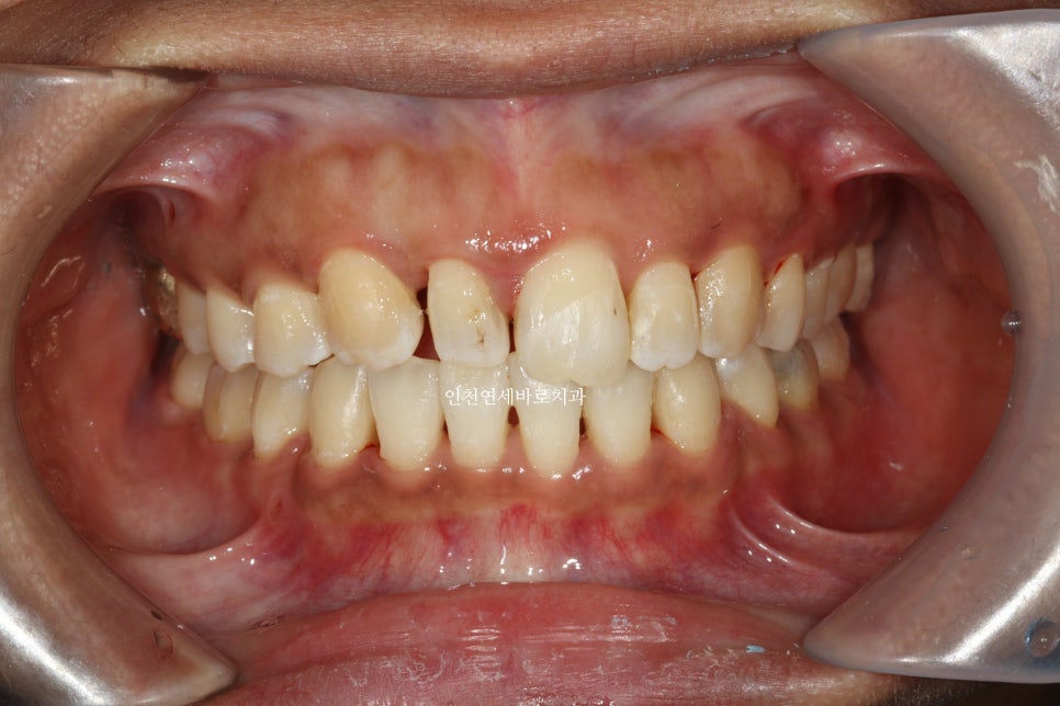앞니가 부러진 경우 임플란트 안하는 방법