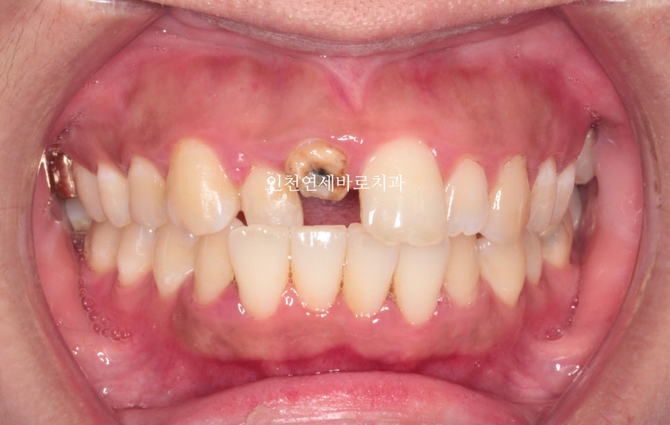 앞니가 부러진 경우 임플란트 안하는 방법