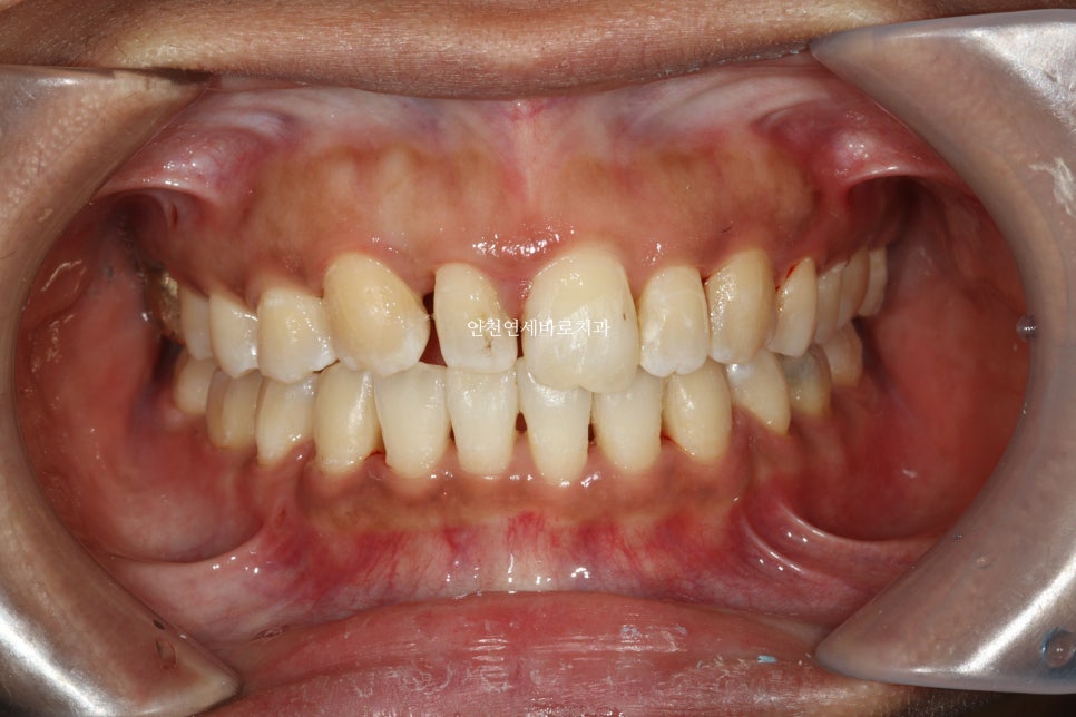 앞니가 부러진 경우 임플란트 안하는 방법