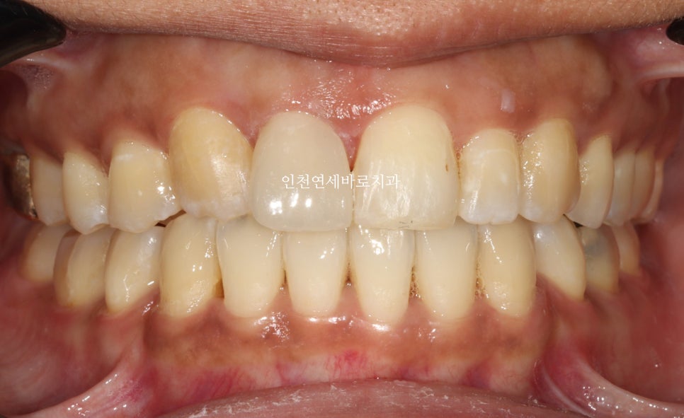 앞니가 부러진 경우 임플란트 안하는 방법