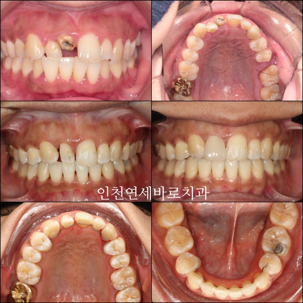 앞니가 부러진 경우 임플란트 안하는 방법