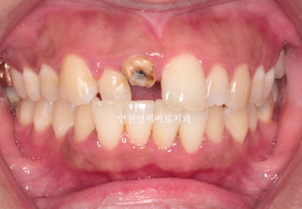 앞니가 부러진 경우 임플란트 안하는 방법