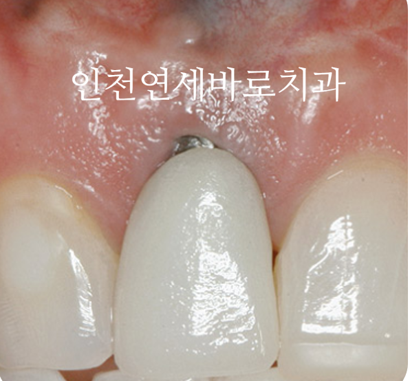 앞니가 부러진 경우 임플란트 안하는 방법