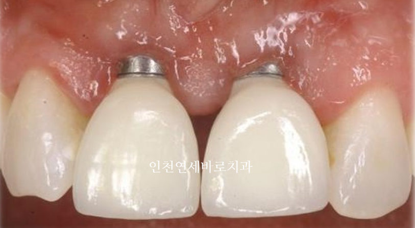 앞니가 부러진 경우 임플란트 안하는 방법