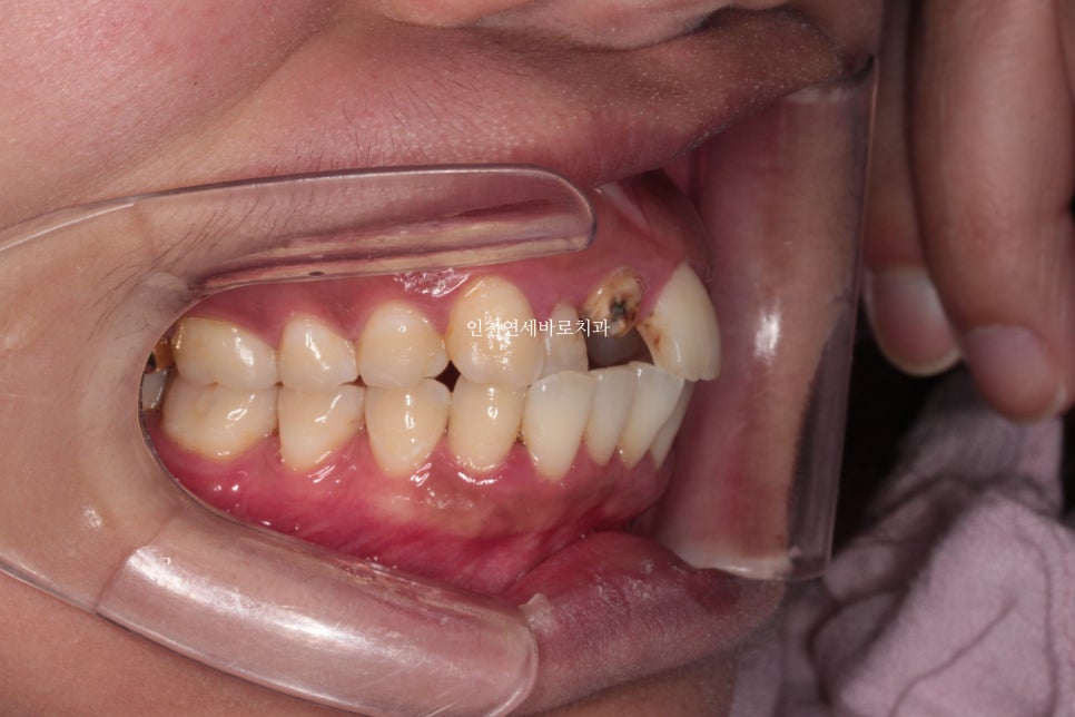 앞니가 부러진 경우 임플란트 안하는 방법