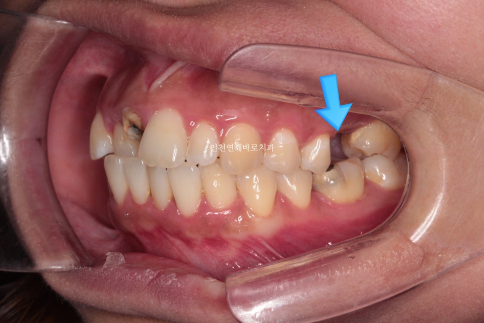 앞니가 부러진 경우 임플란트 안하는 방법