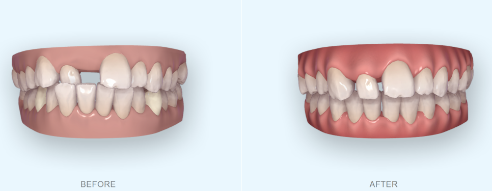 앞니가 부러진 경우 임플란트 안하는 방법