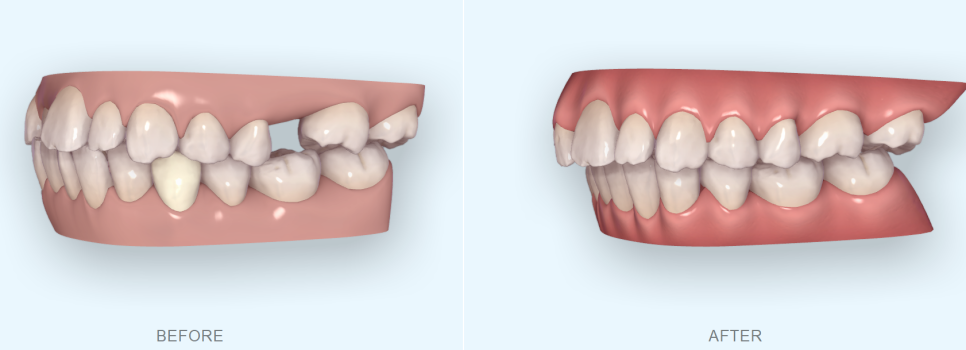 앞니가 부러진 경우 임플란트 안하는 방법