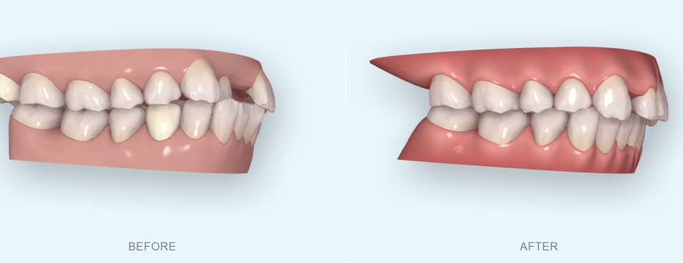 앞니가 부러진 경우 임플란트 안하는 방법