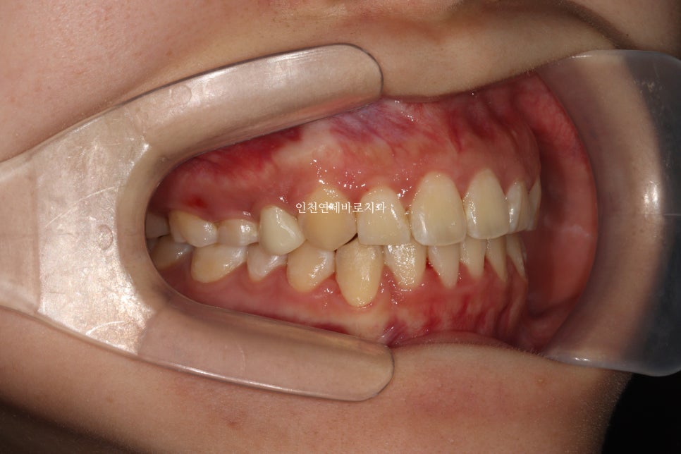 임플란트 있는데 투명교정 인비절라인 가능한가?