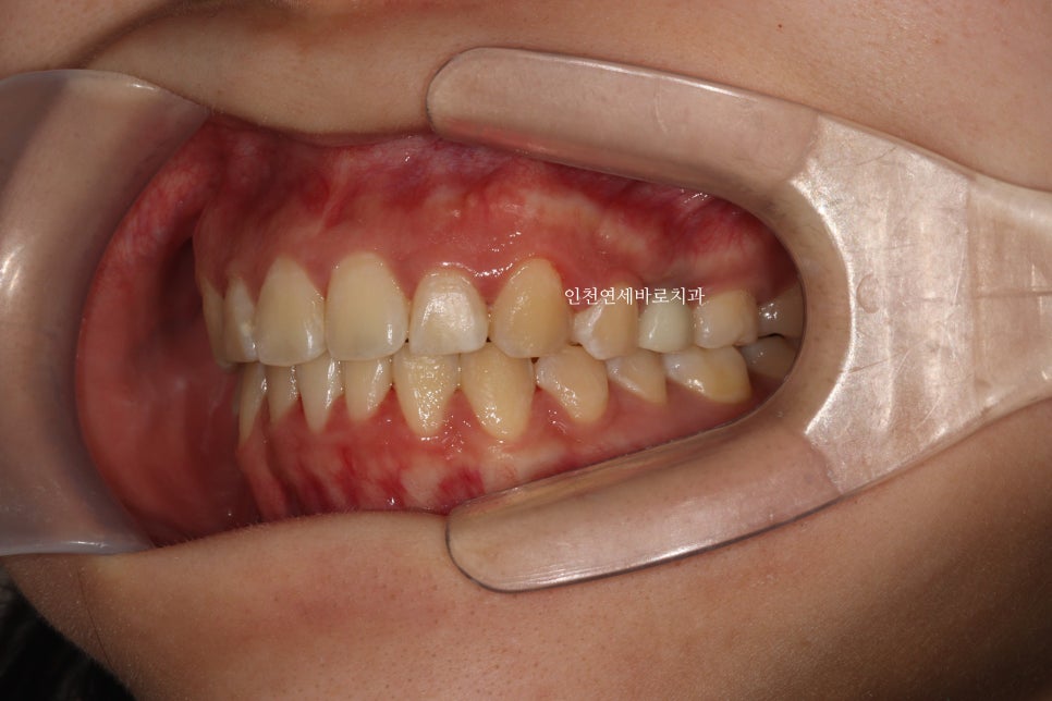 임플란트 있는데 투명교정 인비절라인 가능한가?