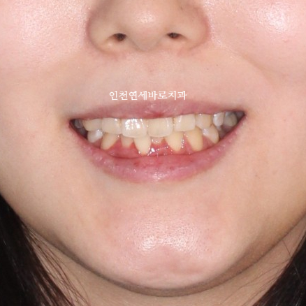 임플란트 있는데 투명교정 인비절라인 가능한가?