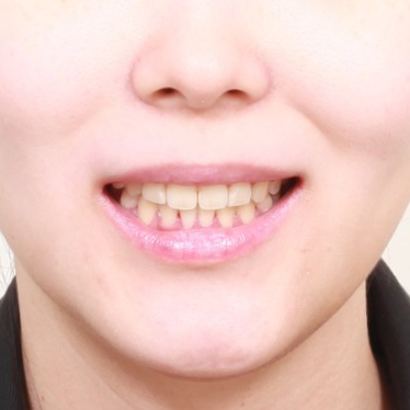 임플란트 있는데 투명교정 인비절라인 가능한가?