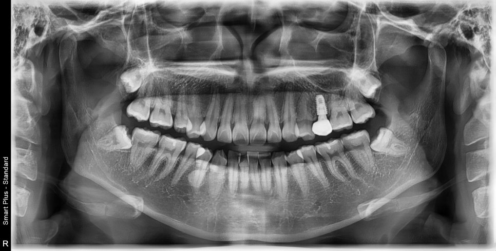 임플란트 있는데 투명교정 인비절라인 가능한가?