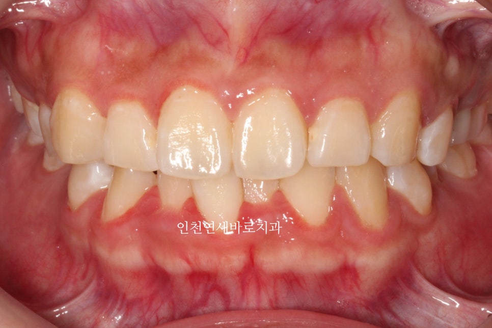 임플란트 있는데 투명교정 인비절라인 가능한가?