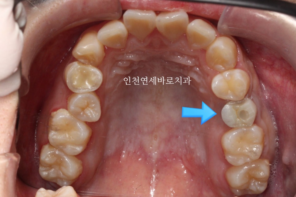 임플란트 있는데 투명교정 인비절라인 가능한가?