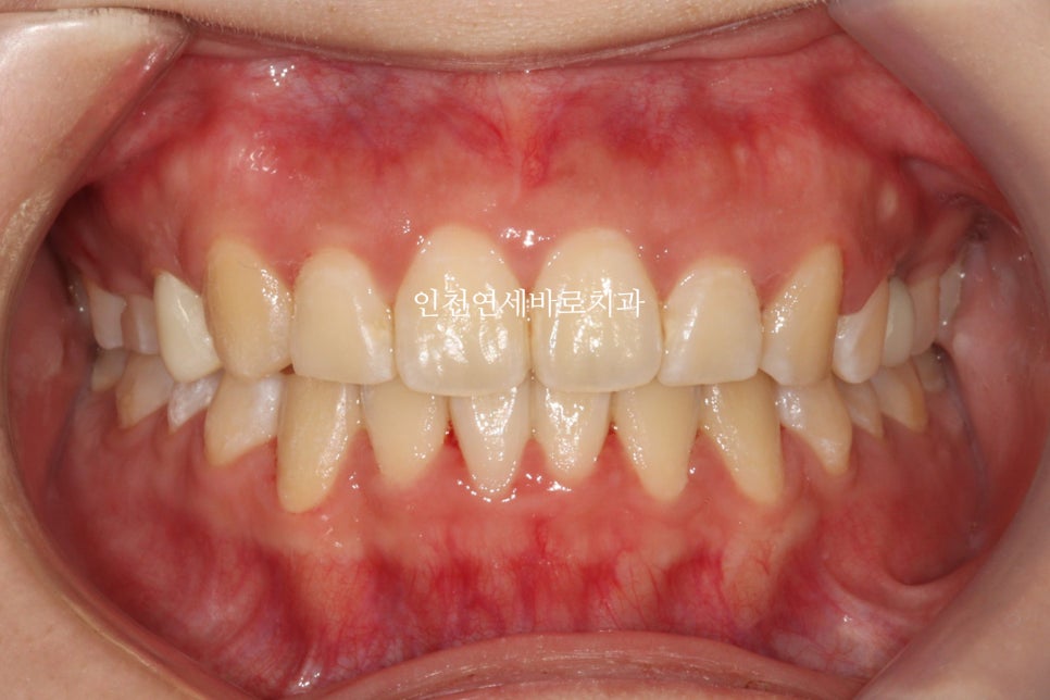 임플란트 있는데 투명교정 인비절라인 가능한가?