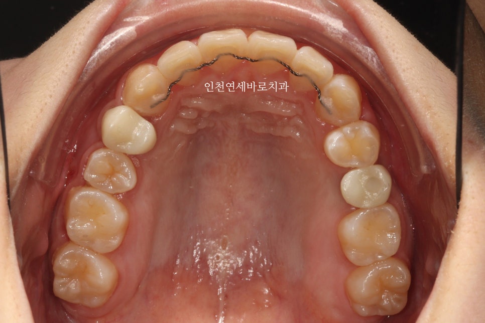 임플란트 있는데 투명교정 인비절라인 가능한가?