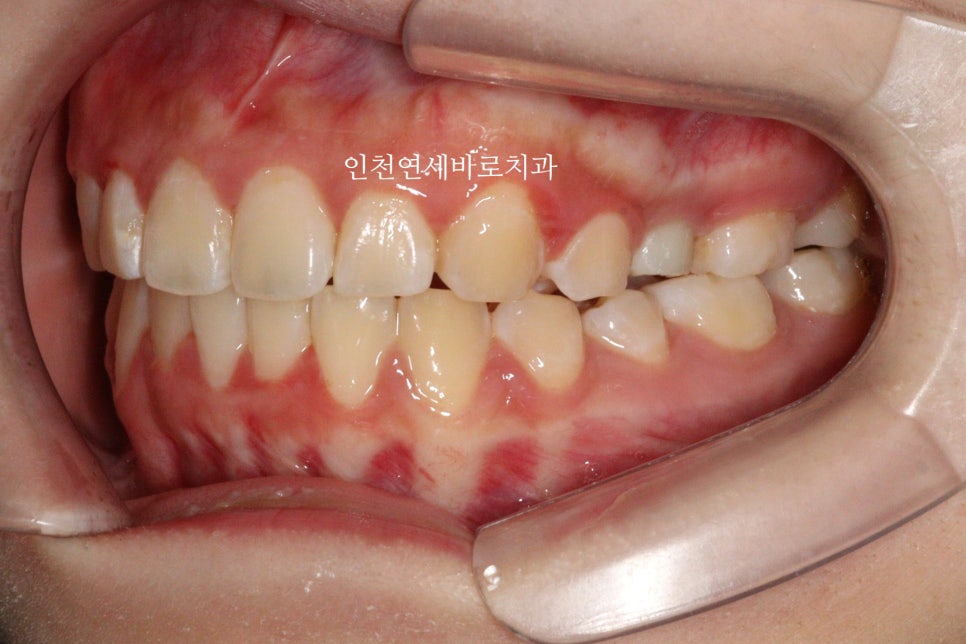 임플란트 있는데 투명교정 인비절라인 가능한가?