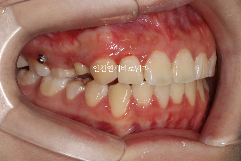 임플란트 있는데 투명교정 인비절라인 가능한가?