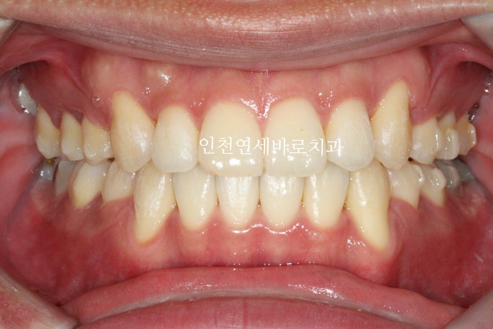 인비절라인 발치 교정 후기 기록, 왜 발치는 안된다고 하는지 이유