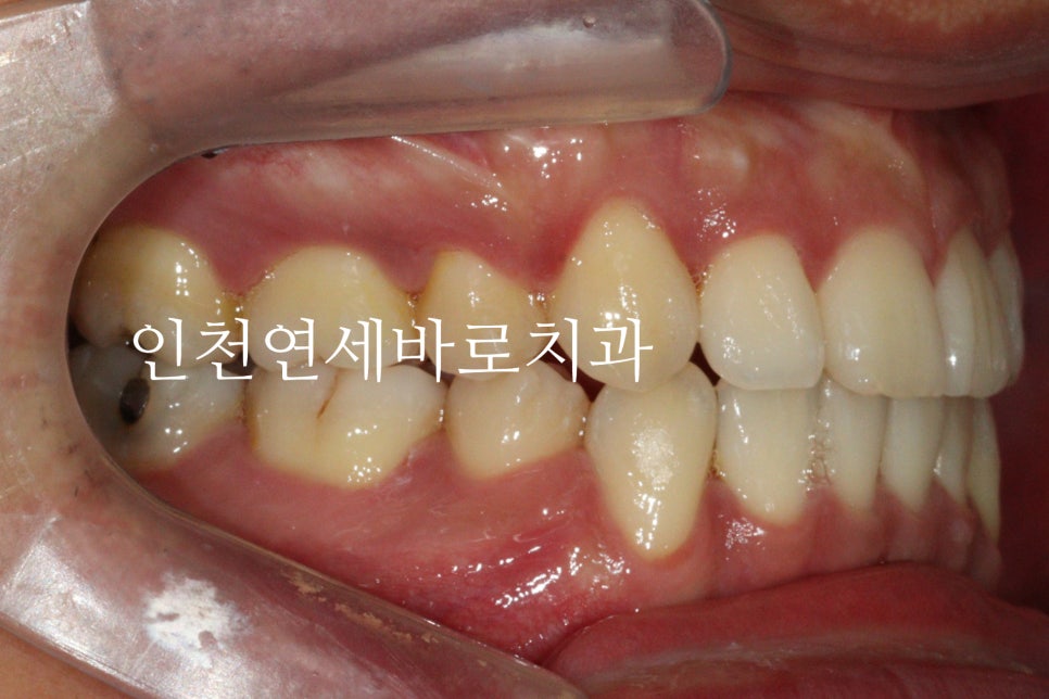 인비절라인 발치 교정 후기 기록, 왜 발치는 안된다고 하는지 이유