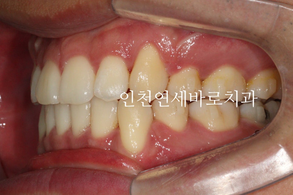 인비절라인 발치 교정 후기 기록, 왜 발치는 안된다고 하는지 이유