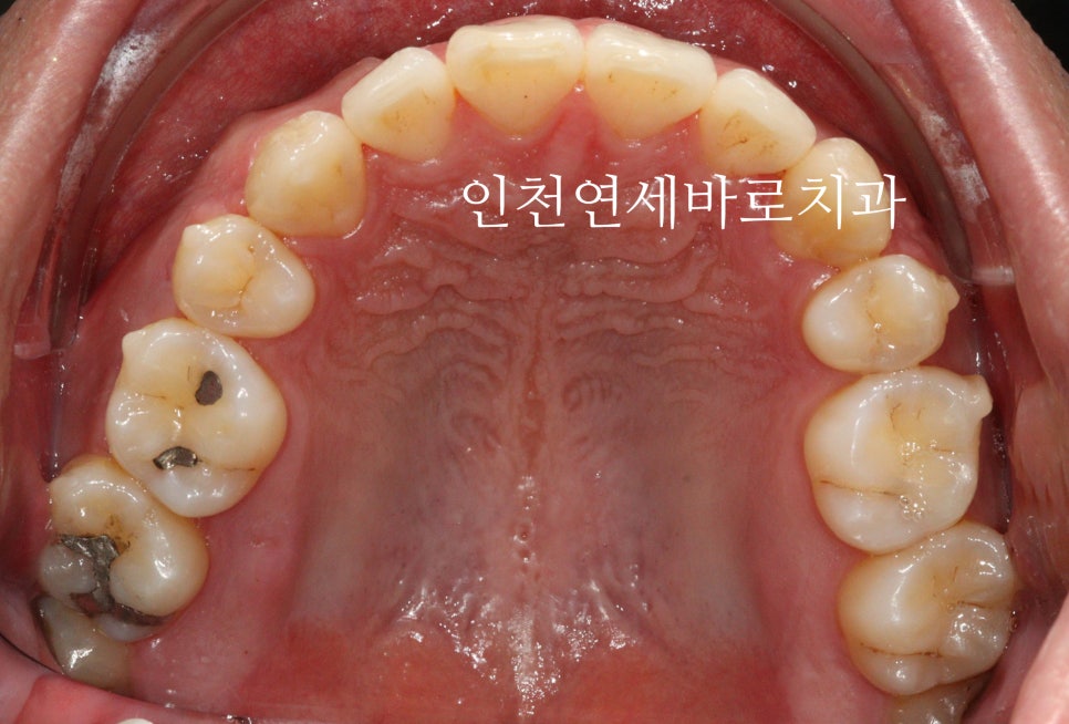 인비절라인 발치 교정 후기 기록, 왜 발치는 안된다고 하는지 이유