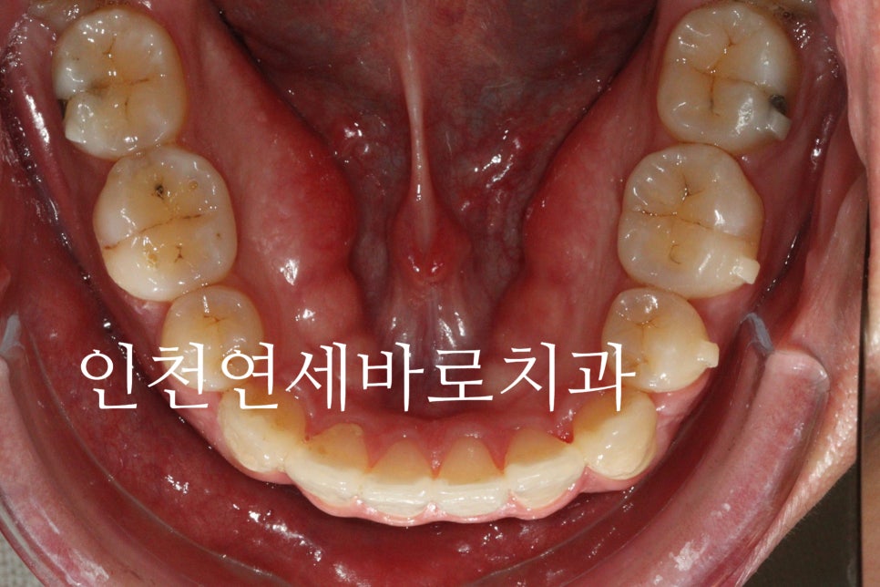 인비절라인 발치 교정 후기 기록, 왜 발치는 안된다고 하는지 이유