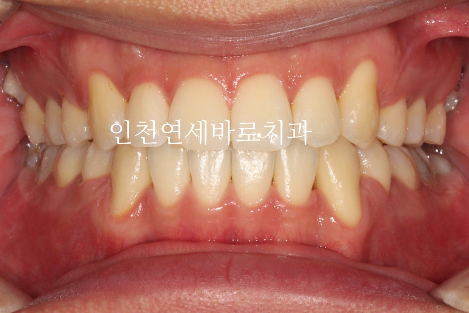 인비절라인 발치 교정 후기 기록, 왜 발치는 안된다고 하는지 이유
