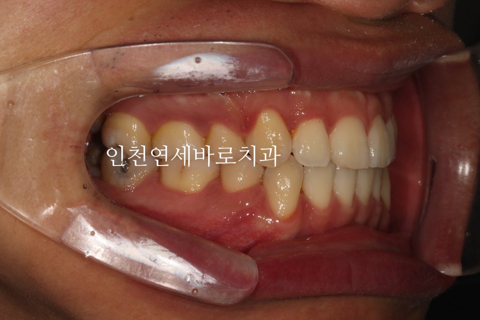 인비절라인 발치 교정 후기 기록, 왜 발치는 안된다고 하는지 이유