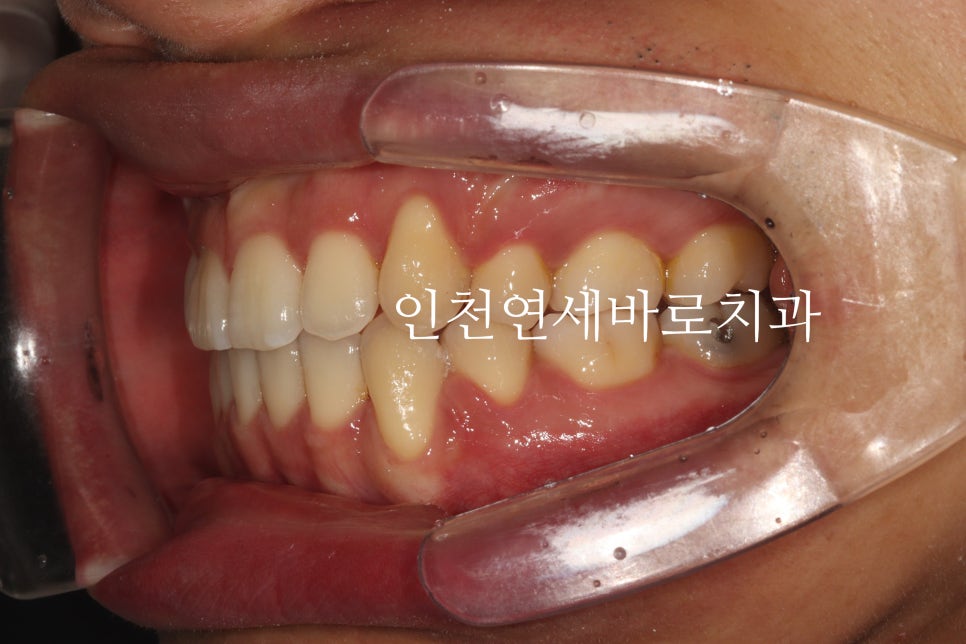 인비절라인 발치 교정 후기 기록, 왜 발치는 안된다고 하는지 이유