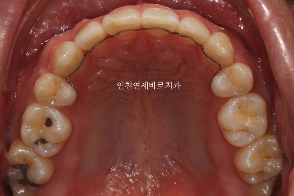 인비절라인 발치 교정 후기 기록, 왜 발치는 안된다고 하는지 이유