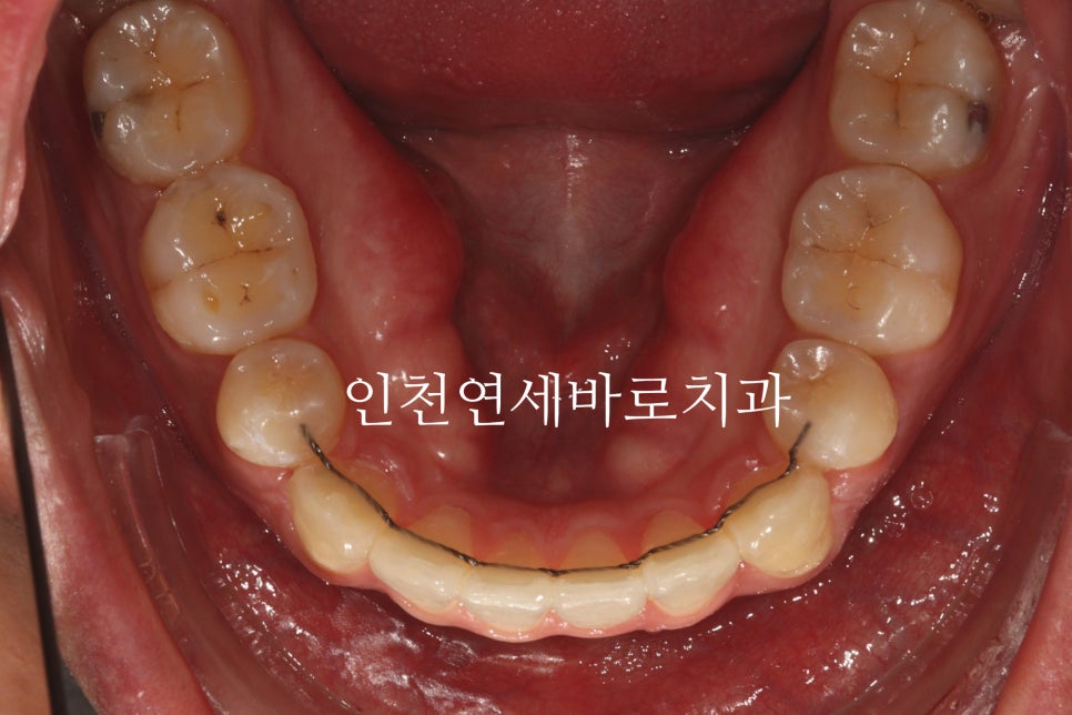 인비절라인 발치 교정 후기 기록, 왜 발치는 안된다고 하는지 이유