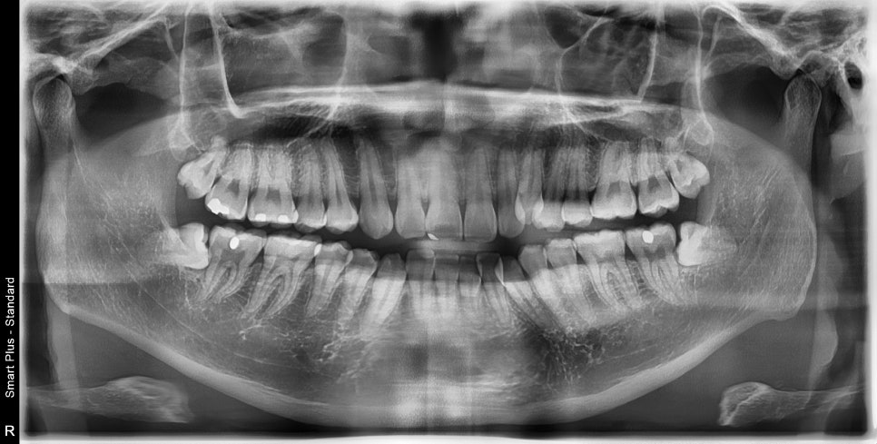 인비절라인 발치 교정 후기 기록, 왜 발치는 안된다고 하는지 이유