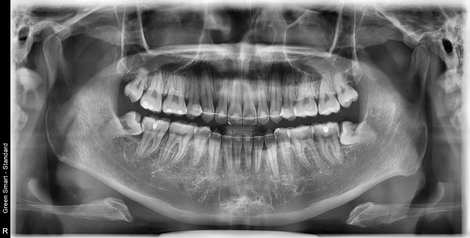 인비절라인 발치 교정 후기 기록, 왜 발치는 안된다고 하는지 이유