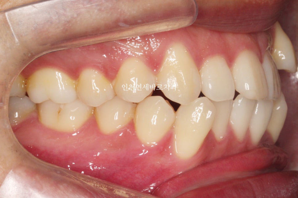 인비절라인 발치 교정 후기 기록, 왜 발치는 안된다고 하는지 이유