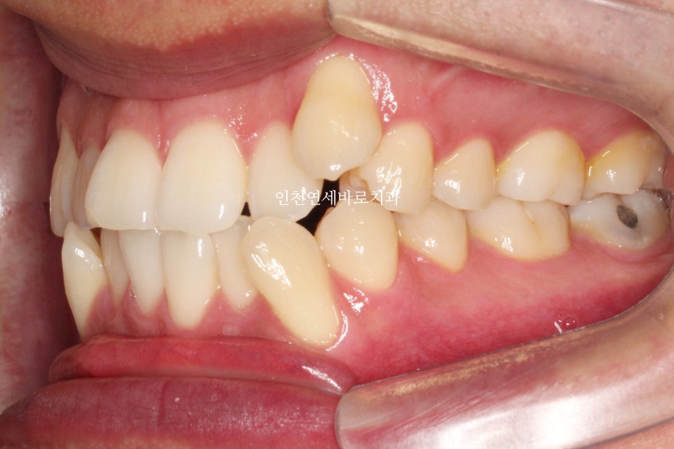인비절라인 발치 교정 후기 기록, 왜 발치는 안된다고 하는지 이유