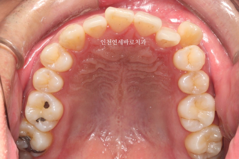 인비절라인 발치 교정 후기 기록, 왜 발치는 안된다고 하는지 이유