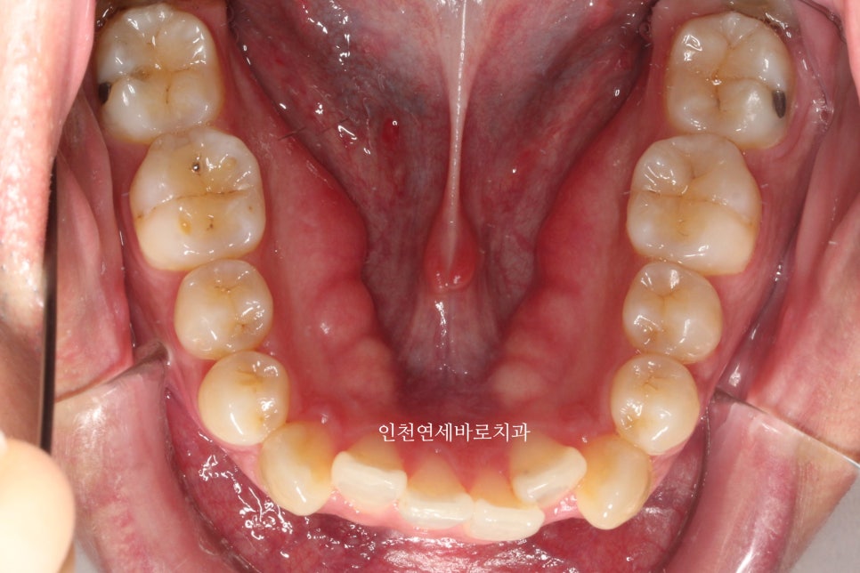 인비절라인 발치 교정 후기 기록, 왜 발치는 안된다고 하는지 이유