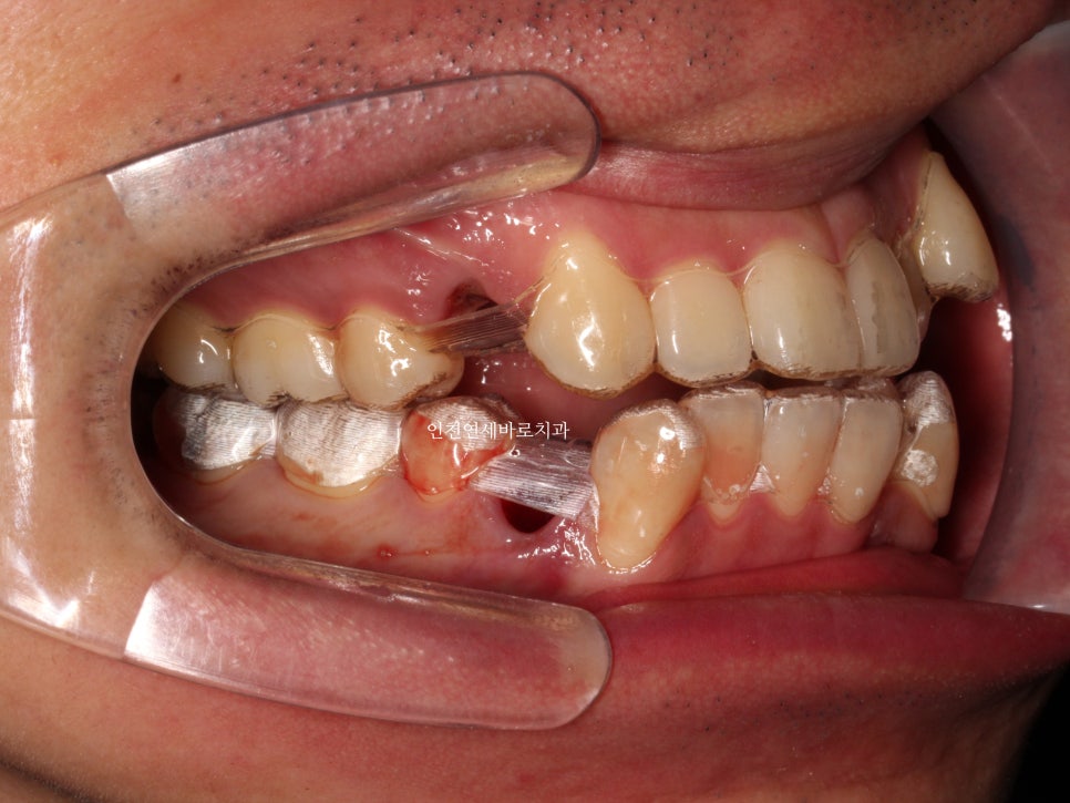 인비절라인 발치 교정 후기 기록, 왜 발치는 안된다고 하는지 이유
