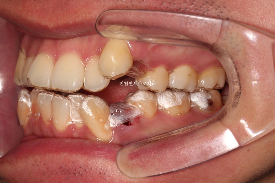 인비절라인 발치 교정 후기 기록, 왜 발치는 안된다고 하는지 이유