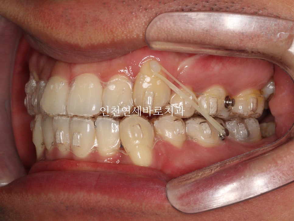 인비절라인 발치 교정 후기 기록, 왜 발치는 안된다고 하는지 이유