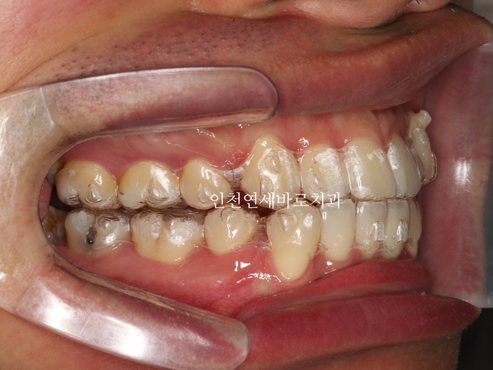 인비절라인 발치 교정 후기 기록, 왜 발치는 안된다고 하는지 이유
