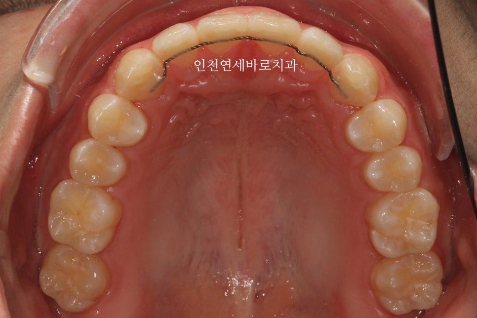 인비절라인 강의 준비하느라 포스팅을 못합니다 인비절라인라이트케이스 하나 공유합니다