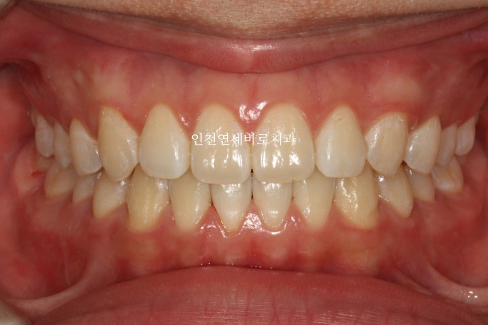 인비절라인 강의 준비하느라 포스팅을 못합니다 인비절라인라이트케이스 하나 공유합니다