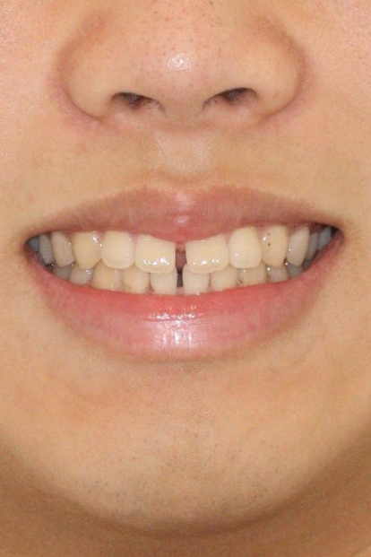 인비절라인 강의 준비하느라 포스팅을 못합니다 인비절라인라이트케이스 하나 공유합니다