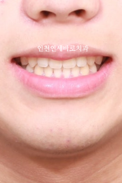 인비절라인 강의 준비하느라 포스팅을 못합니다 인비절라인라이트케이스 하나 공유합니다