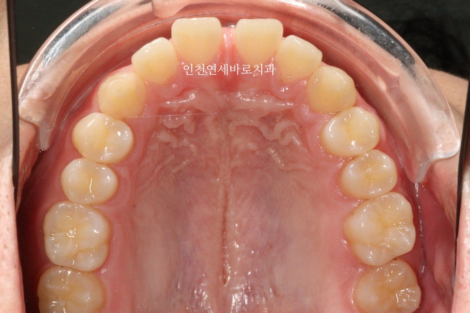 인비절라인 강의 준비하느라 포스팅을 못합니다 인비절라인라이트케이스 하나 공유합니다